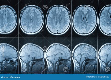 the villages mri head|Head MRI (Magnetic Resonance Imaging) .